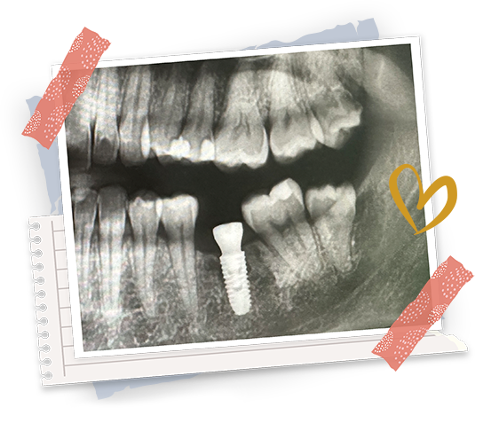 Case Implant Trần Thị Kim Ngân
