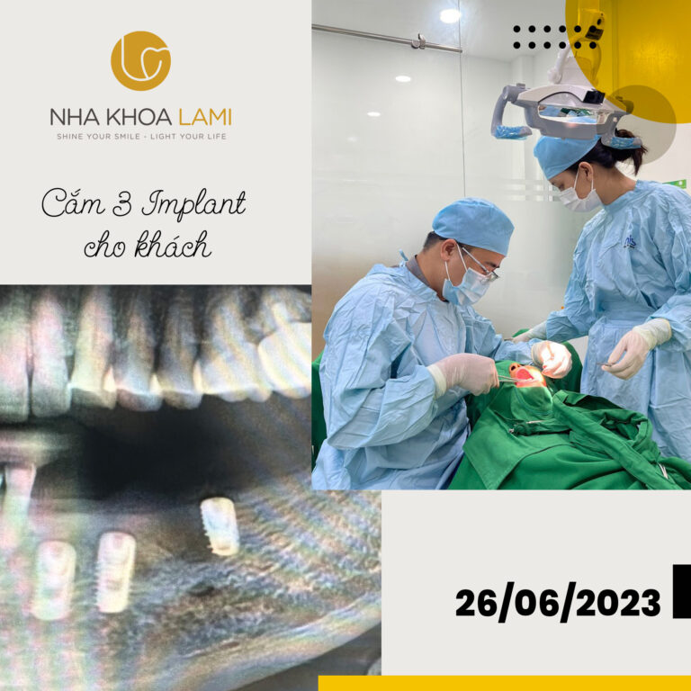 Case cắm 3 Implant cho khách hàng
