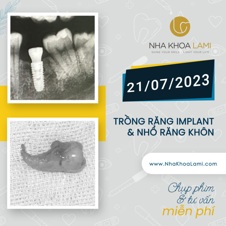 Case răng khôn mọc kẹt và trồng răng Implant cho khách hàng người Nga, anh ấy đang là giáo viên tại Quận 2