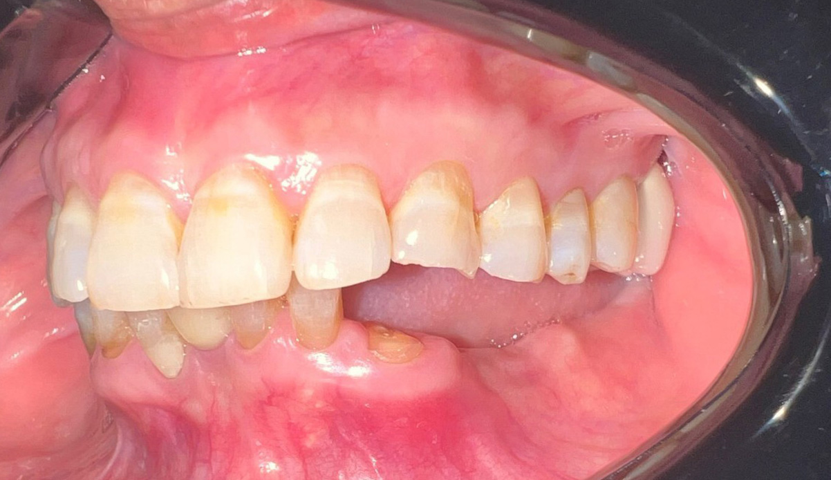 truoc-khi-cam-implant-case-1 truoc-khi-cam-implant-case-1