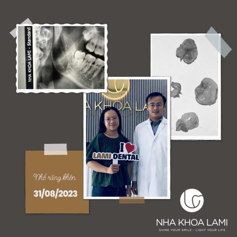 Case nhổ răng khôn khó cho bác sĩ sản khoa.