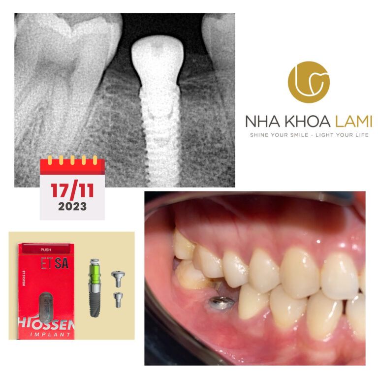 Hoàn thành case cấy 1 trụ Implant_Hiossen cho khách bị mất răng 46.