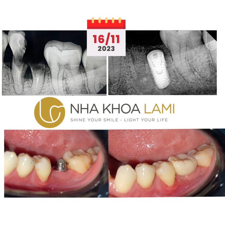Hoàn tất một ca phục hình trên Implant HIOSSEN răng 36 phục hồi lại răng mất cho khách hàng.