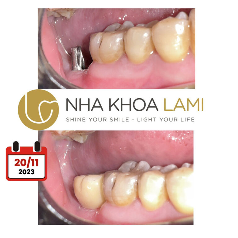 Hoàn tất 1 case phục hình sứ Ziconia trên Implant Hiossen.