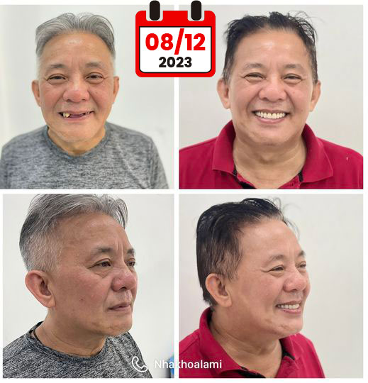 Hoàn tất case phục hình thẩm mỹ toàn hàm Implant All on 4