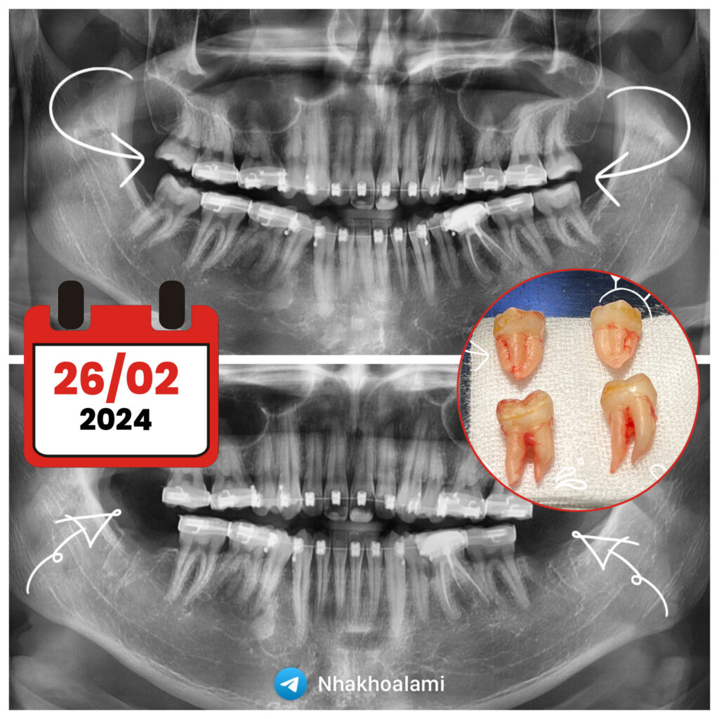 rang-khon-lami-2602 case nhổ 4 răng khôn tại nha khoa lami thủ đức
